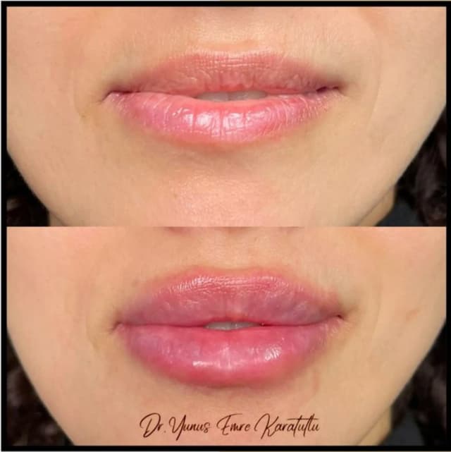 Before After 1